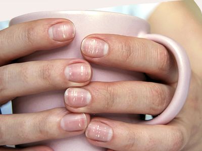 لکه‌های سفید روی ناخن‌ها چه معنایی دارند؟