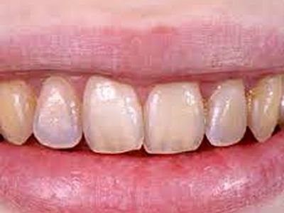 برای تقویت مینای دندان چه کنیم؟