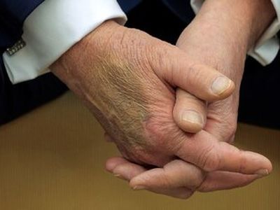 کبودی خبرساز روی دست ترامپ / آیا ترامپ سالم است؟ / کاخ سفید: کبودی ناشی از دست دادن زیاد است