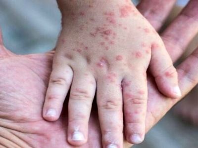 تزریق واکسن سرخک در سفر اربعین برای چه افرادی ضروری است؟/ لزوم انجام واکسیناسیون دو هفته قبل از سفر