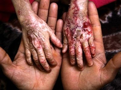 تجهیزات لازم برای شناسایی بیماران نادر وجود ندارد/جلوی واردات "پانسمان‌‌های ویژه بیماران ای‌بی" با قیمت نازل گرفته شد