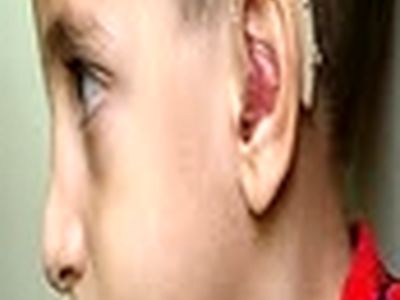 پرداخت کمک هزینه سی میلیون ریالی کاشت حلزون گوش