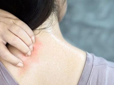 نکات طلایی برای پیشگیری و درمان عرق‌سوز شدن