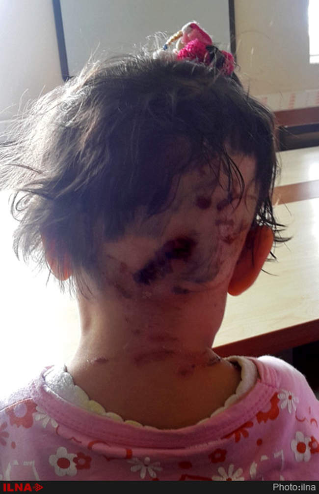 حمله 5سگ ولگرد به دختر بچه چهارساله در روستای یزن آباد از توابع شهرست