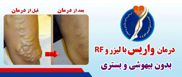 متخصص درمان واریس