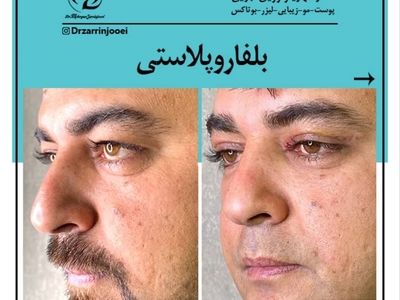 رفع پف چشم و افتادگی پلک با روش بلفاروپلاستی