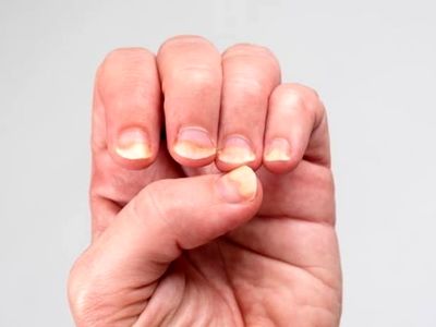 مهم ترین عوامل و علل زرد شدن ناخن های دست و پا