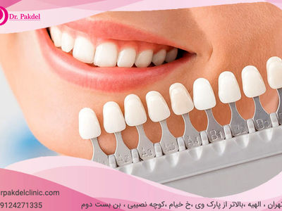 کامپوزیت دندان چیست؟ تفاوت کامپوزیت و لامینیت