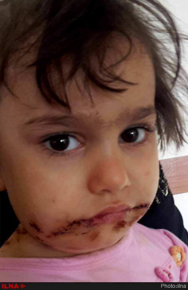 حمله 5سگ ولگرد به دختر بچه چهارساله در روستای یزن آباد از توابع شهرستان نمین استان اردبیل