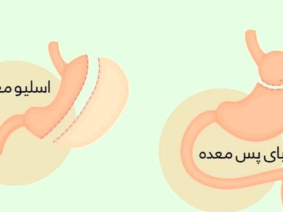 عمل اسلیو بهتر است یا بای پس؟ + مقایسه