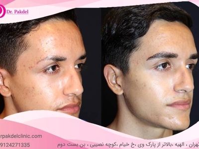 کاشت ابرو طبیعی چیست و چگونه انجام می‌شود؟