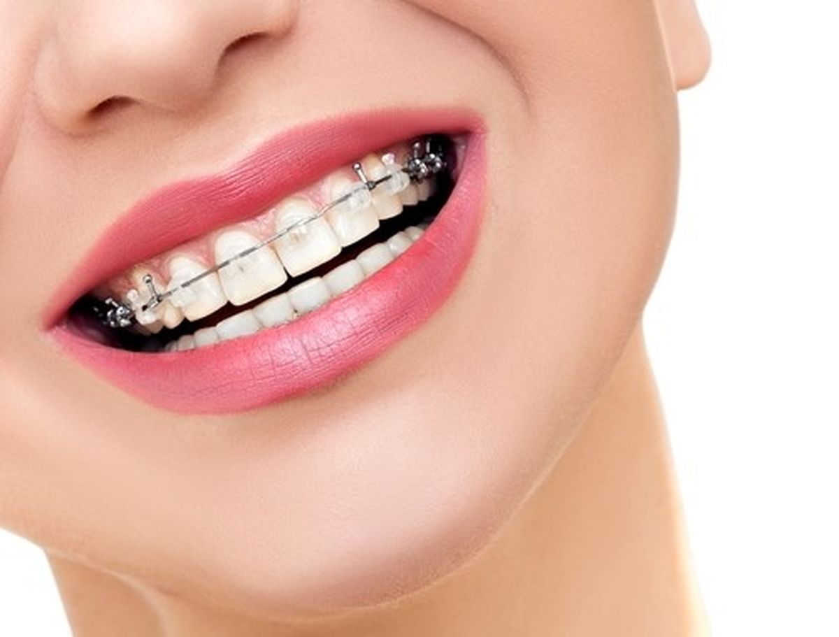 ارتودنسی متحرک چیست و برای چه کسانی مناسب است؟