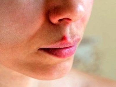 تبخال را سه دقیقه ای ناپدید کنید