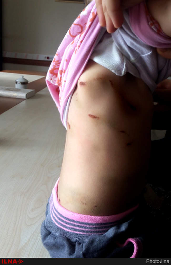 حمله 5سگ ولگرد به دختر بچه چهارساله در روستای یزن آباد از توابع شهرست�