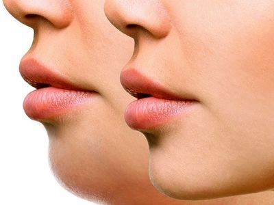 بهترین روش های از بین بردن غبغب بدون عمل جراحی