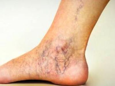 برای پیشگیری از واریس چه غذاهایی را نباید خورد