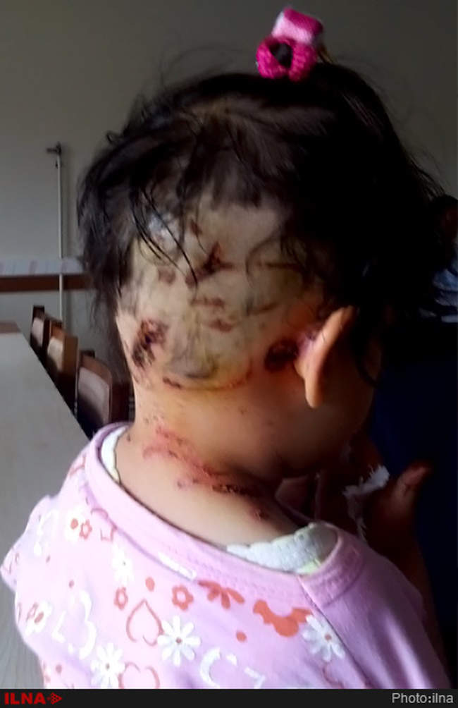 حمله 5سگ ولگرد به دختر بچه چهارساله در روستای یزن آباد از توابع شهرست